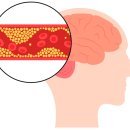 뇌졸중 전조증상은, ‘이것’? 이미지