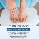 성남 정자역 발톱무좀, 약치료 어려울 때 관리 방법