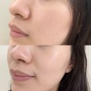 정바이오 | 잠실 피부관리 프롬미 에스테틱 바이오힐 관리 후기