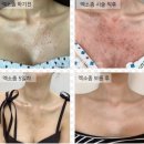 (주)타토아 | 울쎄라 효과를 극대화하는 엑소좀 홈케어 루틴 ,시술 후기