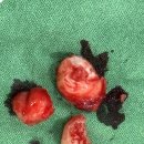 젊은신경과의원 | [아산 사랑니 발치] "사랑니 통증, 성별과 나이에 따라 정말 다를까?" 통계와 의학적 진실