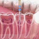 예미지강치과의원 | 익산모현치과 신경치료 잘하는 곳을 찾는다면?