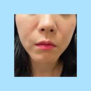 온네트 | 여의도 피부과에서 팔자주름과 마리오네트 주름 5g리프팅으로 한번에 해결한 찐 리얼후기