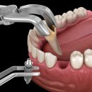 진해치과의원 | 진해임플란트치과, 가격만 봤다가 1년만에 빠지고 후회합니다