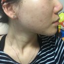 차차한의원 | 모낭염 한의원 깨끗하게 치료 후기