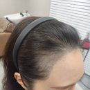 💉 [두피문신] 데모모델 후기 — 공짜 시술이 수백만 원짜리 복구가 된 사연 😱