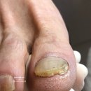옥정약국 | 옥정 무좀발톱 레이저? 더욱 효과 올려주는 케어 후기