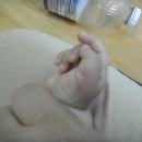 더블유(W)병원 오른손 엄지 무지 다지증 8월19일 수술 두달후 상태 이미지