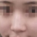 코필러 후기 레스틸렌 효과 전후 총정리