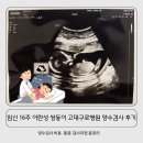 대중병원 | 고대구로병원 양수검사 후기, 임신 16주 이란성 쌍둥이 양수검사 비용, 통증, 검사 과정 총정리