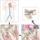 전극도자절제술[Catheter ablation] 이미지