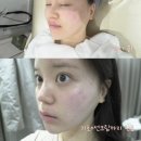 수앤수 | 부천여드름관리 “수앤수뷰티끄” 좁쌀여드름 고민 해결 후기