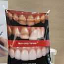 평택하얀치과의원 | 평택치과 치아미백 + 무삭제 라미네이트 솔직 후기