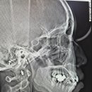 미소그리다치과교정과치과의원 | 나의 치아교정 일기-1(대구치아교정,치아교정,반월당치아교정치과추천)