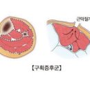 구획증후군 원인 급성 구획증후군 구획증후군 예방법 이미지