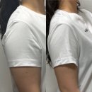 안산 뉴동안산병원점 | 안산 지방분해주사 예비신부관리 팔뚝 5회차 솔직후기