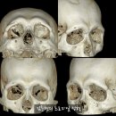 미드라인성형외과의원 | 꼭 이마거상과 함께 해야만 하는 수술인가요? 미드라인성형외과에서 하는 눈썹뼈절삭 수술을 설명...