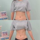 일센치뷰티 | 부천다이어트관리 셀포랩 니즈점 : 1회 만에 복부 5cm 줄어든 찐 후기