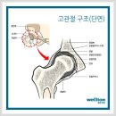 고관절골절시,145수술법과 121회복프로그램을 통한 고관절인공관절수술!! 이미지