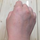 알레르기 이미지