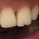 정치과의원 | 앞니 깨짐 레진 가격 치료 시간송파 연세굿플란트치과 찐 후기