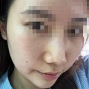 신논현역 피부과 색소레이저 치료 후기(퍼펙트토닝,원데이 글로우업)다운타임X,멍X