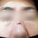 포커스성형외과의원 | 부천 코 봉합 성형외과 치료 후기 : 흉터 없이 회복된 사례