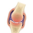 무릎관절질환의 증상과 치료 이미지