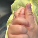 서울화외과의원 | 19개월 아기 손가락 화상치료/의정부 서울화외과/화상 진료비