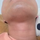 세상의모든아름다움의원 | [강남 세예의원] 남자 턱 전체 레이저제모, 젠틀맥스프로플러스, 7회 받은 후기 및 현재 상태 - 내돈내산