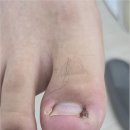 골든메디 | 대전 탄방동 내성발톱 안아프게 관리 잘하는 곳 추천! 골든풋 대전점 페디쿱스