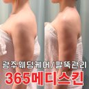 장등로19번길L | 광주웨딩관리 승모근 팔뚝 라인 정리 잘하는 곳 365메디스킨