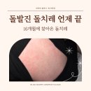 대로(보)2-1-5 | 돌치레 돌발진 열꽃 언제 사라질까 열보초 후기