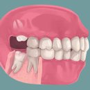 나음치과의원 | 사랑니 발치 - 꼭 뽑아야 하나요? 매복사랑니 비용부터 회복까지 완벽 정리