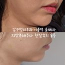 동광로12가길 16 | 압구정피부과 이중턱 울쎄라 지방분해주사 한달후기 통증 내돈내산