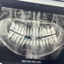 김치과의원 | [턱관절 장애의 완치 여정...8] 갑자기 턱에서 날카로운 소리가 나다 <서울센텀턱구강내과치과의원 후기>