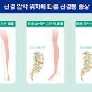 허리다리저림 증상과 자가 진단 및 생활 습관 개선 방법 이미지