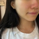 보름달 | 강남 블랙헤드 보름달뷰티 플라토닝 테라피 솔직 후기