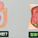 장폐색증과 장유착의 차이점과 예방법 이미지