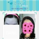 헤어라인교정후기 상콤