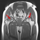 [고관절] 고관절 통증, 혹시 나도 대퇴골두무혈성괴사? 이미지
