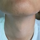 앤플러스의원 | [남자수염제모] 남악 유앤아이의원 레이저 제모 후기