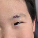 바로일성형외과의원 | 아이 눈썹 열상 봉합 후기 | 분당 한땀 성형외과 방문 기록