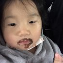 송영화 | 아기혈관종 치료 후기 (hemangioma) - 네번째 이야기 인데놀 한달째 다시 복용중 _건양대병원(송영화...