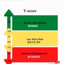 골다공증 정상 수치 검사 골다공증에 좋은 음식 이미지