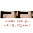 V-10 | 기미제거 끝이 보이다 ! 레블라이트, 엑셀V, 피코토닝 레이저 10회 리얼 내돈내산 후기