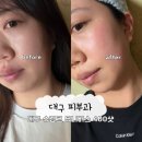 라인 - 부천시 원미구 송내대로73번길 46 | 대구피부과슈링크유니버스 400샷 심부볼 이중턱 라인 정리 후기