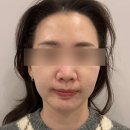 3361 | 수원피부관리실 [휴에스테틱]에서 피부진정 LDM 받은 후기