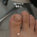 레푸스 | 여의도 내성발톱 관리 후기 | 레푸스 영등포여의도점