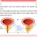 남자 여성 잔뇨감 원인 체크 이미지